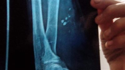 إهمال داخل مستشفى العريش.. سائق يطالب بمحاسبة طبيب نسي زجاجًا داخل ذراعه | صور