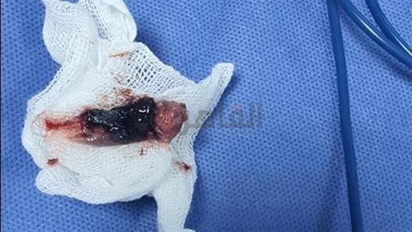 تسجل أول عملية استئصال