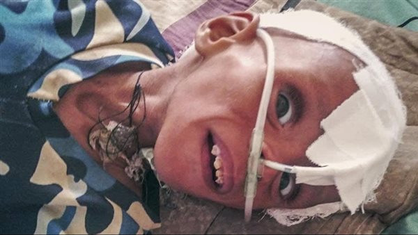 طفل يعاني من المجاعة