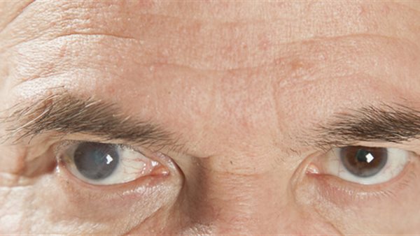 اعتام العين