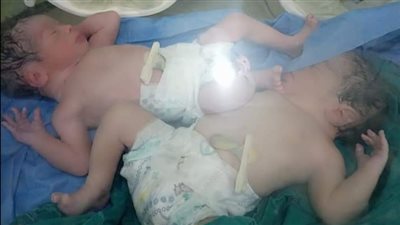 إحداهما توأم.. إجراء حالتي ولادة قيصرية بمستشفى حجر كفر الدوار | صور