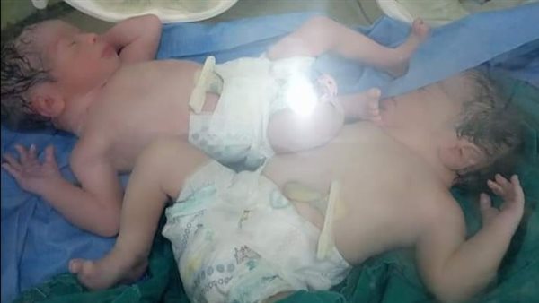 توأم بمستشفى الحجر