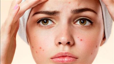 الوجبات السريعة والشيكولاتة.. أطعمة تساعد على زيادة بثور الوجه