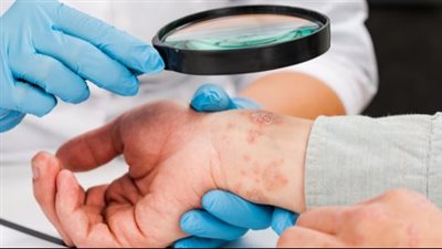 6 أعراض جلدية تشير إلى إصابتك بـ أوميكرون