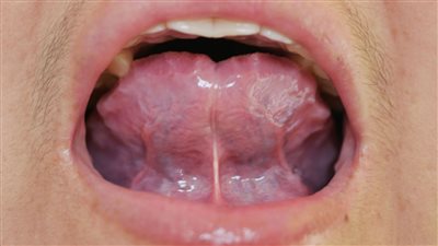 في 3 أيام.. علاج تقرحات الفم بالملح والخل والطحينة 