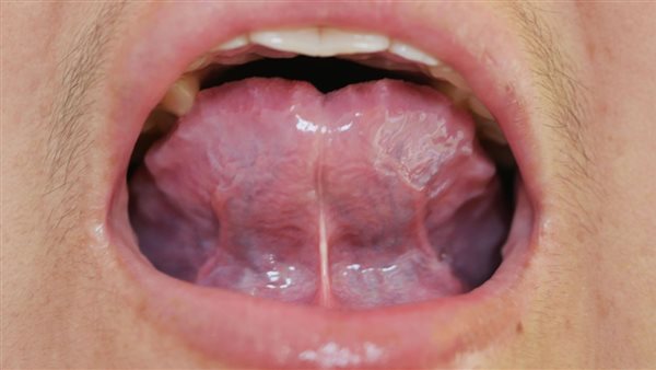 علاج تقرحات الفم