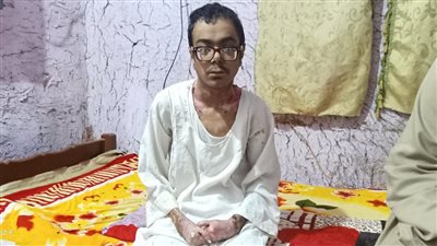 مستشفى أسوان الجامعي يكشف الحالة الصحية لـ مريض الفقاعات الوراثية