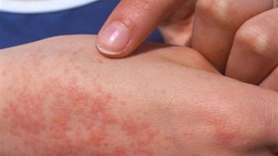 منها الحمي المالطية.. أمراض تنقلها الحيوانات الأليفة إلى الإنسان