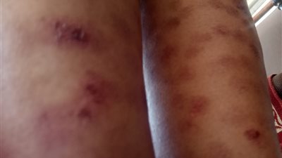 الطبيبة السبب.. تفاصيل تعرض سيدة لحروق جلدية نتيجة خطأ طبي 