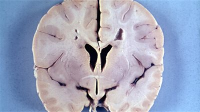  مرض الاسكندر...مرض نادر يصيب الأطفال والرضع
