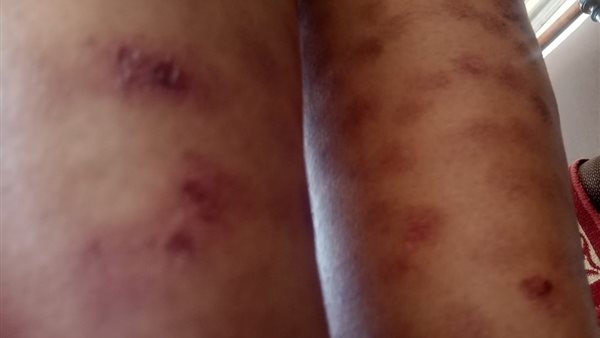 إصابة مريضة خلال