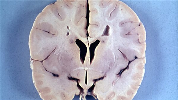 مرض الاسكندر