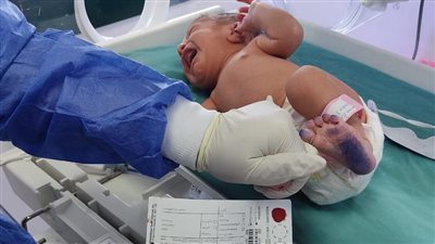 الصحة: فحص 45 ألف طفل حديثي الولادة للكشف المبكر عن الأمراض الوراثية