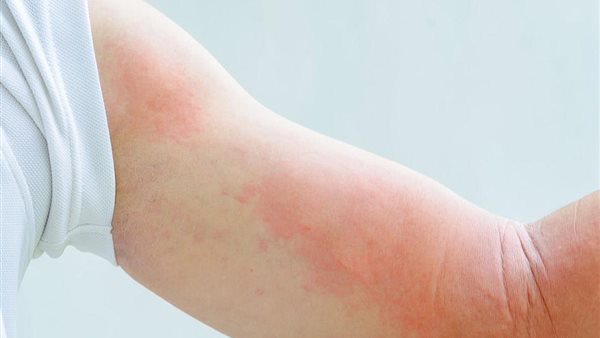 مرض الأرتكاريا