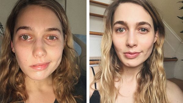  متلازمة هنت