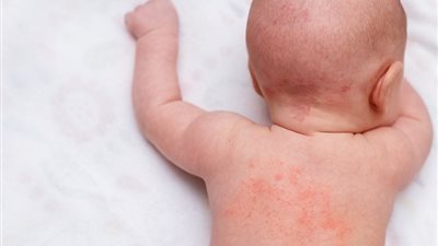 استشاري أمراض جلدية يوضح أهم أسباب حدوث الحمونيل والوقاية منه