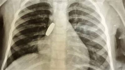 طلقة خرطوش.. الأطباء يكتشفون جسم غريب داخل طفلة