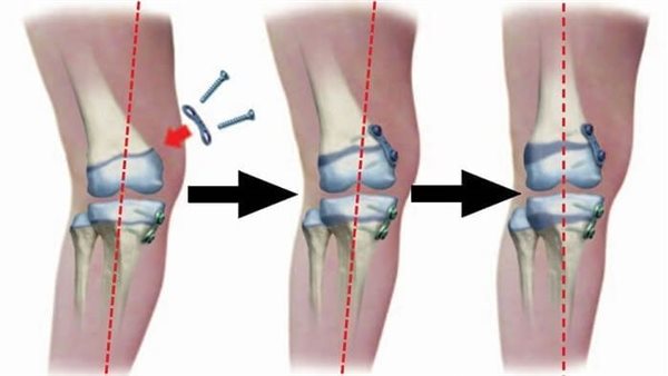 جهاز لعلاج تقوس الساقين