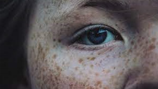 متلازمة كارني 