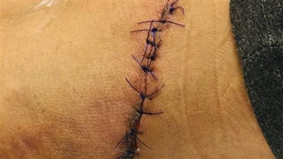 التحقيق في اتهام مسئولي مدرسة بطنطا بالإهمال والتسبب بإصابة تلميذ بـ 65 غرزة