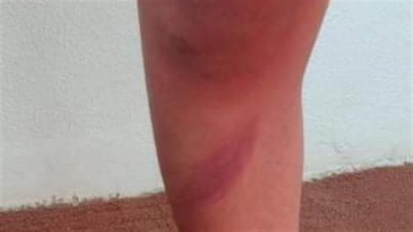  آثار ضرب الطالب