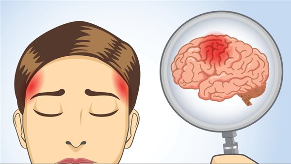 أسباب الصداع المستمر