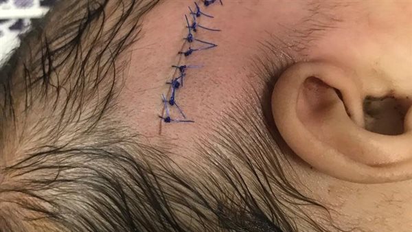 إصابة رضيعة بسنجة