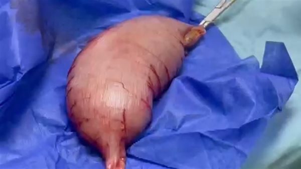 إجراء جراحة نادرة