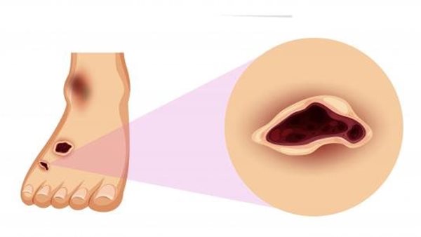 تأثير مرض السكر على