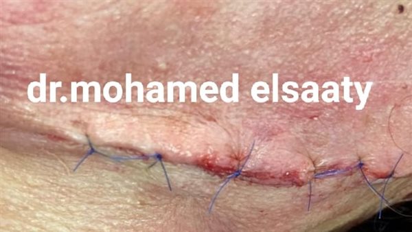 نجاح عملية جراحية