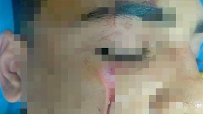 تعليم المنوفية: استبعاد معلم تسبب في إصابة طالب بجرح استلزم 15 غرزة بالوجه 