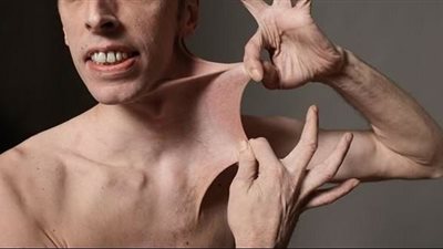 تعرف على أسباب وطرق علاج متلازمة إهلرس دانلوس