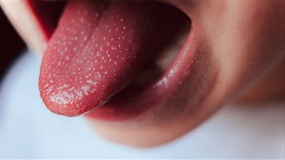 استشاري أطفال: متلازمة كاوازاكي من أخطر مضاعفات فيروس كورونا على الأطفال 