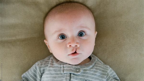 الشفة الأرنبية 