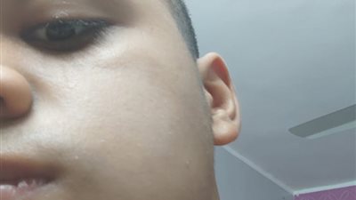 كسر فك طالب بعد الاعتداء عليه داخل مدرسة بشبرا الخيمة