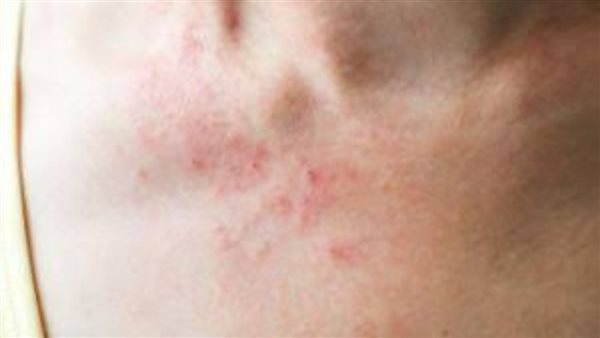 مرض الساركويد