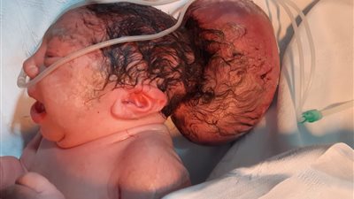 أرجوكم أنقذوا ابني الوحيد من الموت.. أب يستغيث بالسيسي بعد ولادة طفله بكيس مياه به جزء من المخ | صور