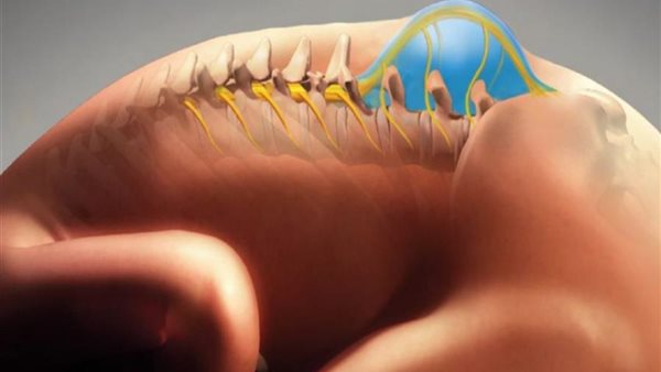 الصلب المشقوق