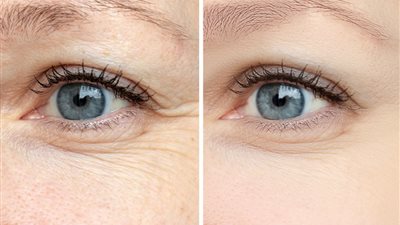 من بينها عدم ترطيب العين.. تعرف على أسباب ظهور تجاعيد العين عند الشباب 