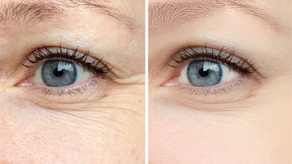 تجاعيد العين 