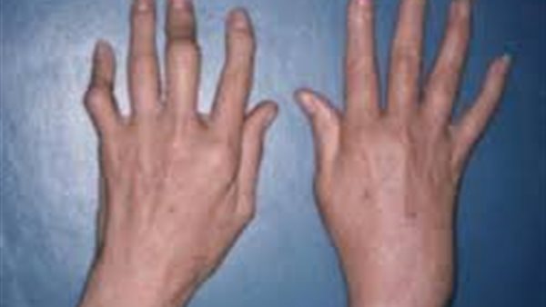 متلازمة رايتر