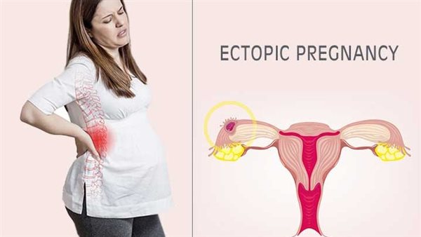 أعراض الحمل خارج