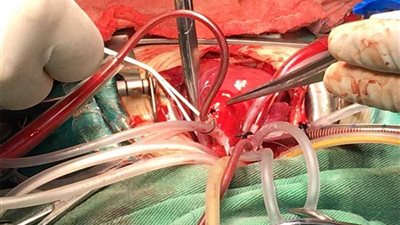 الرعاية الصحية تعلن نجاح عملية قسطرة طرفية لمريض يبلغ 59 عاما بالأقصر