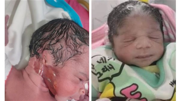 حالات ولادة نادرة