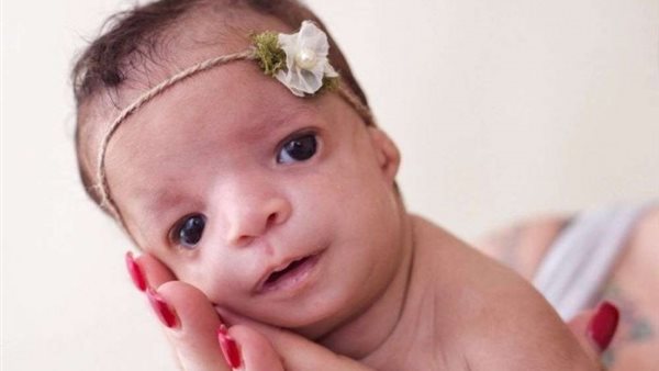 تشوة الأجنة 