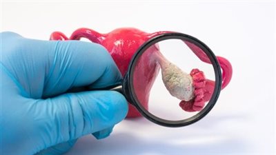 بالغذاء والرياضة.. علاج تكيس المبايض للمتزوجة بالتفصيل