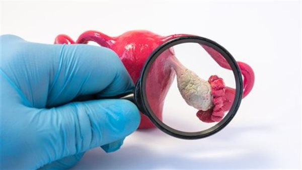 علاج تكيس المبايض