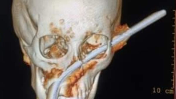 سيخ حديد داخل وجه