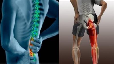أعراض الانزلاق الغضروفي في الورك.. هل يسبب عرق النسا؟