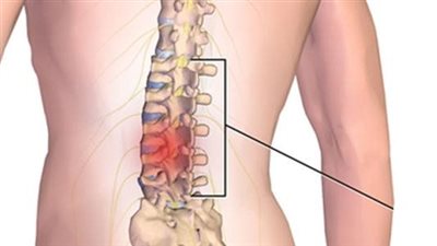 خطوات عملية الغضروف الفقرة الرابعة والخامسة